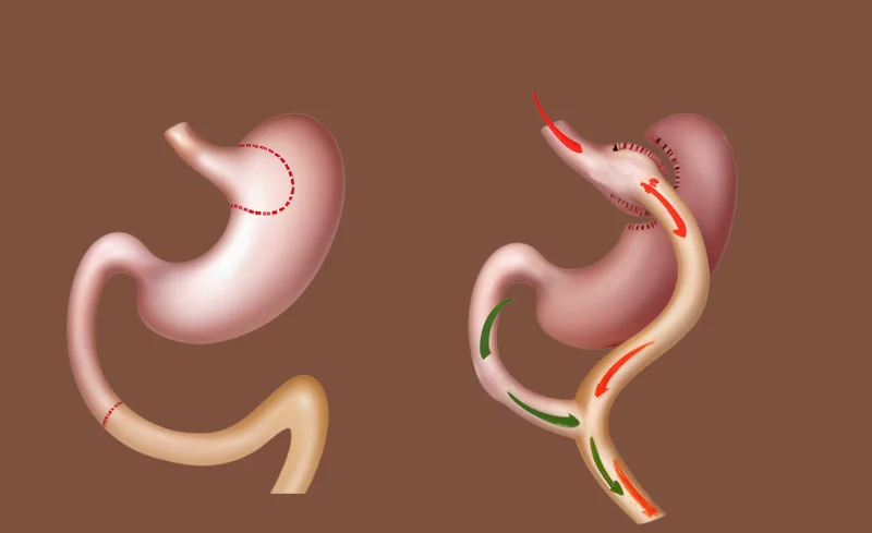 comparing the normal stomach to a gastric bypass procedure, showing how the stomach is reduced and the intestine is rerouted.