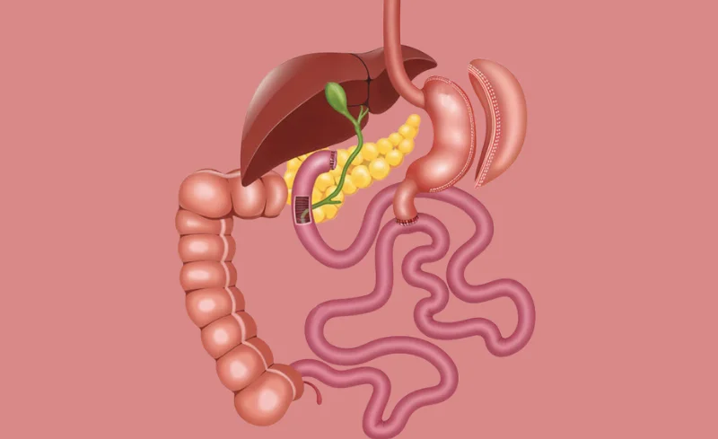 The digestive system showing the stomach, liver, gallbladder, pancreas, and intestines with surgical connections.