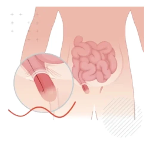 An inguinal hernia with intestines protruding through the lower abdominal wall in the groin region.