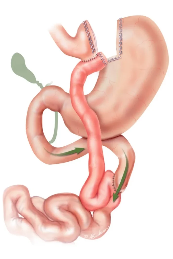 Gastric bypass reroutes the stomach and intestine to support weight loss and improve metabolic health.