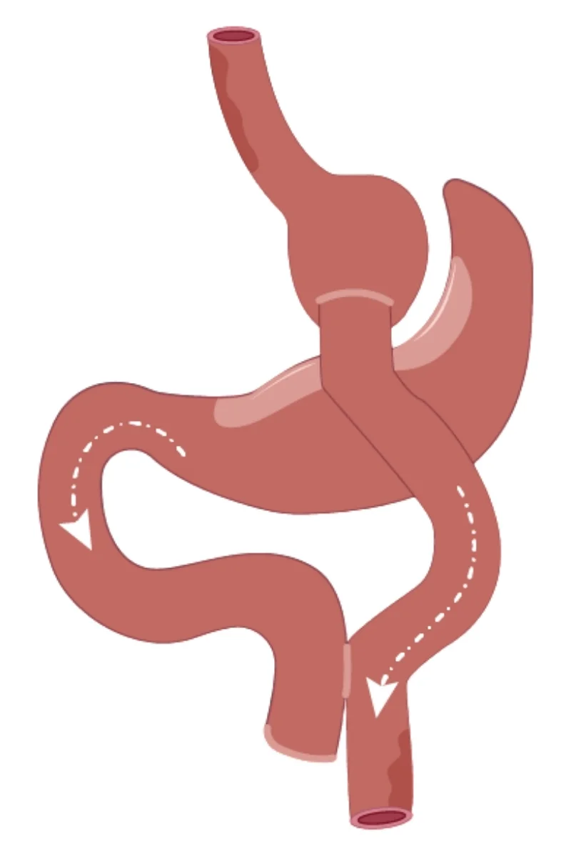 iew of a Bariatric Surgery procedure, detailing a simplified gastric bypass operation.