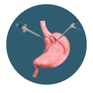 A stomach being stitched during a laparoscopic surgery using two surgical instruments.