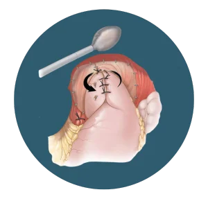 Medical illustration showing the stomach being stitched during a surgical procedure, with sutures closing the incision.