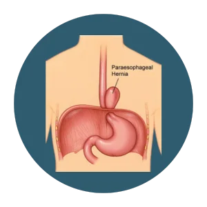 Showing a paraesophageal hernia, where part of the stomach pushes up through the diaphragm beside the esophagus.