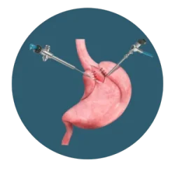 A stomach being stitched during a laparoscopic surgery using two surgical instruments.