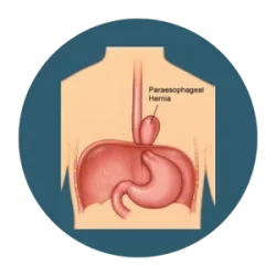 Showing a paraesophageal hernia, where part of the stomach pushes up through the diaphragm beside the esophagus.